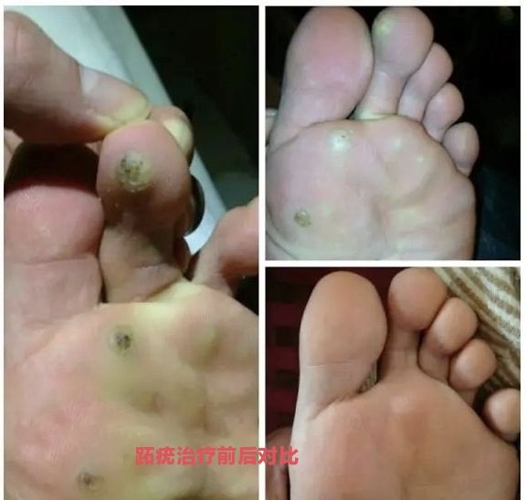 专业修脚：甲沟炎 灰指甲 鸡眼 脚气 本人从事修脚行业二十余年 无效退款 三堂新新家园南门 足益生