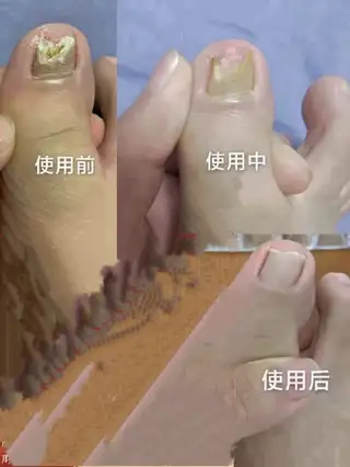 专业修脚：甲沟炎 灰指甲 鸡眼 脚气 本人从事修脚行业二十余年 无效退款 三堂新新家园南门 足益生